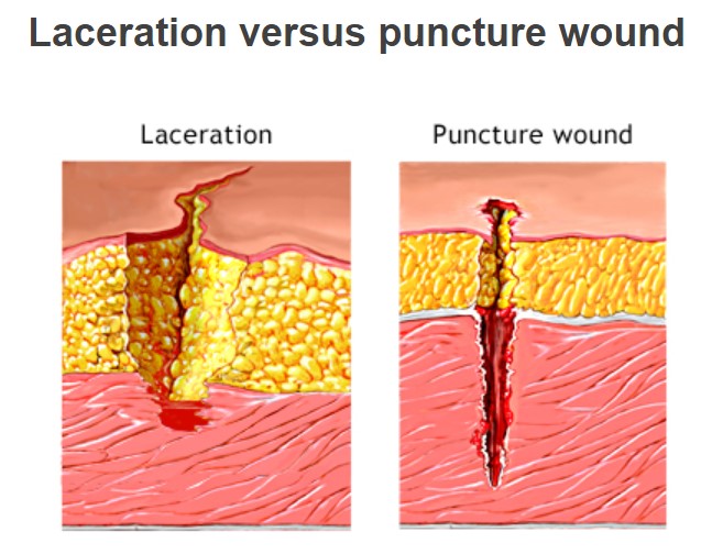 ansi puncture